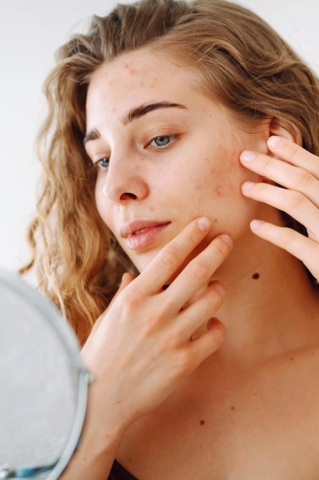 женщина с гиперандрогенией смотрит в зеркало на акне